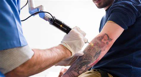 Understanding Laser Tattoo Removal: A Comprehensive Guide for Coventry Residents